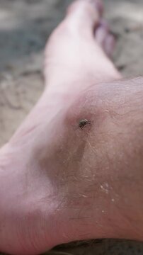 A small fly rests on a person hairy bare leg skin outdoors. Concept of insect bites, pest control, -borne disease transmission, summer irritation, and bug repellent protection.