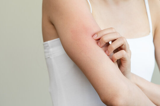 Dermatology, asian young woman reaction from atopic, insect bites on her arm, hand in scratching itchy red spot or rash of skin. Healthcare, treatment of beauty.