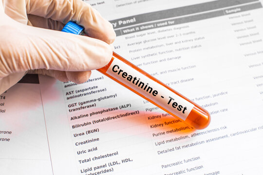 blood sample in lab tube for Creatinine test