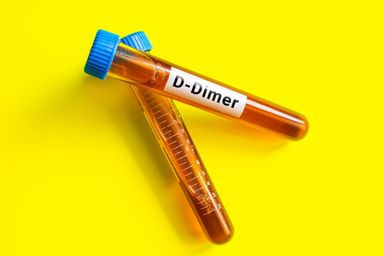 blood sample in lab tube for D-Dimer test