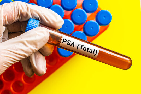 blood sample in lab tube for PSA (total) test