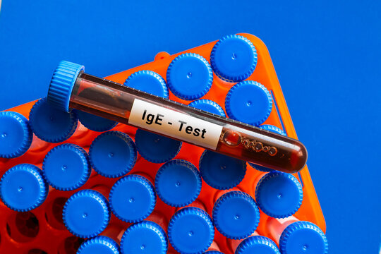 blood sample in lab tube for IgE test