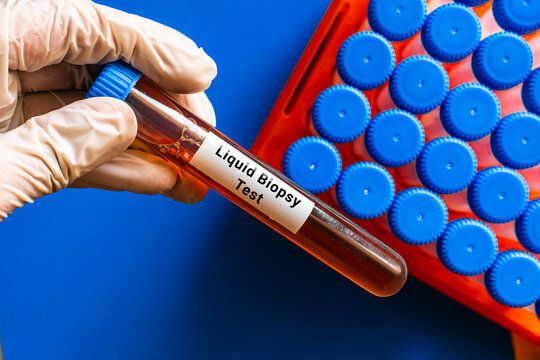 blood sample in lab tube for Liquid Biopsy test