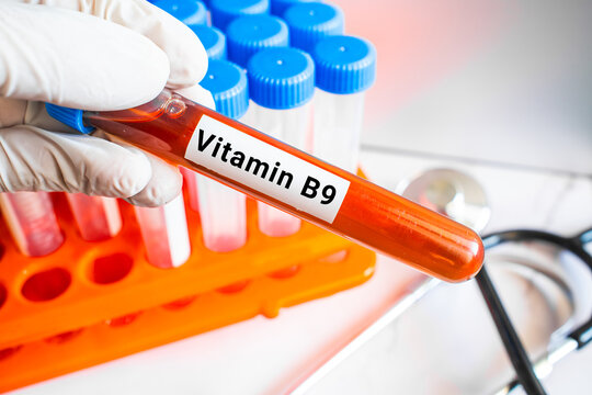 blood sample in lab test tube for Vitamin B9