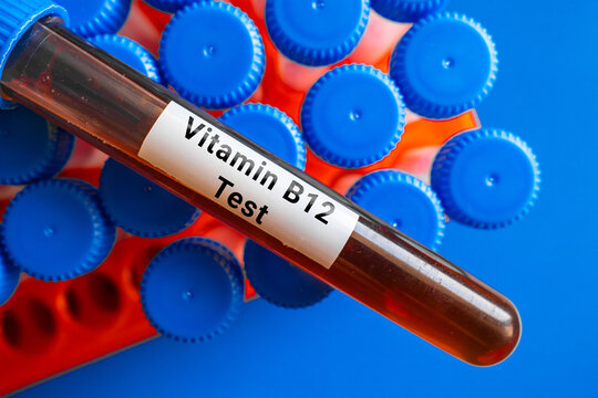 blood sample in lab test tube for Vitamin B12