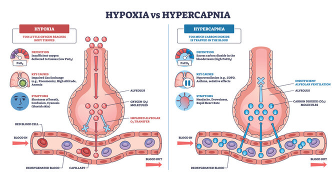 Hypoxia vs Hypercapnia comparison explains disrupted gas exchange using alveolus, capillary, and O2-CO2 molecules to contrast low oxygen and CO2 retention. Outline diagram