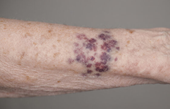 Senile purpura ecchymosis and dark purple blood spots on fragile elderly skin arm for geriatric dermatology