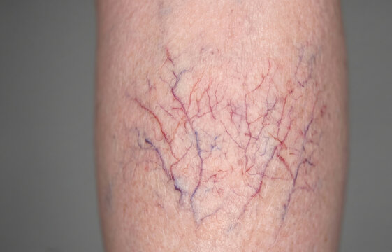 Spider Veins