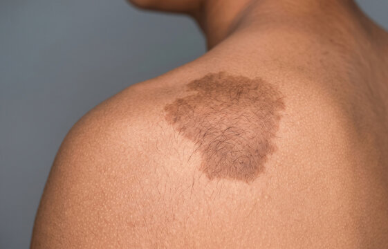 Large Becker nevus hyperpigmented hairy birthmark patch on male shoulder and upper back skin surface