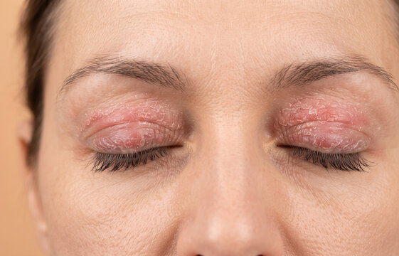 Close Up of Severe Eyelid Dermatitis Eczema with Dry Flaky Red Skin