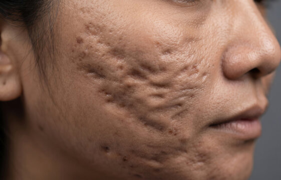 Severe atrophic acne scars including icepick and boxcar scarring on adult female cheek skin surface