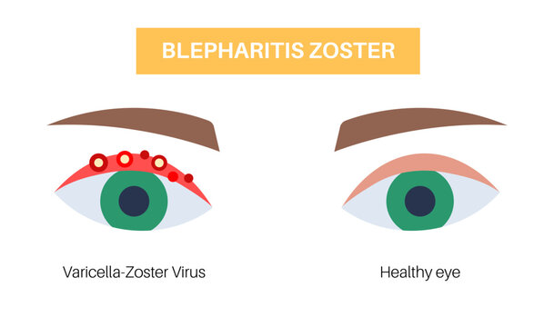 Varicella zoster comparison scheme