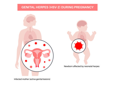 Pregnancy neonatal herpes transmission