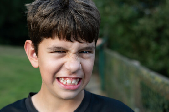 Playful young boy scrunches his face into a toothy grin while standing outdoors. The boy is cute but he has malocclusion and crooked teeth, he needs to see dentist and orthodontist