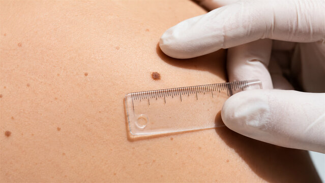 dermatologist examining a skin mole with a transparent ruler for melanoma screening. Closeup medical examination illustrating skin cancer prevention, diagnosis, and dermatology care