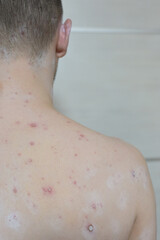Naklejka premium Chickenpox varicella zoster virus rash. Vesicles papules, ulcers, crusts on the skin of an adult male back. Skin disease. Dermatology. Treatment