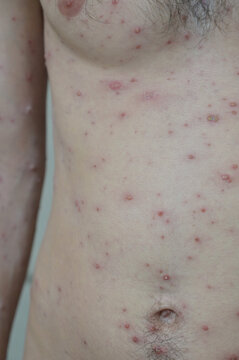 Chickenpox varicella zoster virus rash. Vesicles papules, ulcers, crusts at different stages on the skin of an adult male torso. Skin disease. Dermatology. Treatment