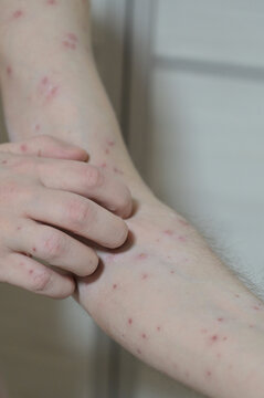 Chickenpox varicella zoster virus rash. Vesicles papules, ulcers, crusts on the skin of an adult male hands. Skin disease. Dermatology. Treatment