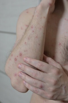 Chickenpox varicella zoster virus rash. Vesicles papules, ulcers, crusts on the skin of an adult male hands. Skin disease. Dermatology. Treatment