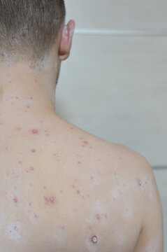 Chickenpox varicella zoster virus rash. Vesicles papules, ulcers, crusts on the skin of an adult male back. Skin disease. Dermatology. Treatment