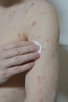 Treatment of ulcers from Chickenpox varicella zoster virus rash with medical cream using a cotton pad on the adult man skin. Skin disease. Dermatology