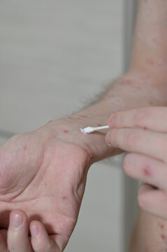 Treatment of ulcers from Chickenpox varicella zoster virus rash with medical cream using a cotton swab on the adult man skin. Skin disease. Dermatology