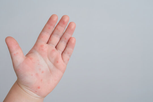 Viral Skin Lesions on Fingers and Palm, Close-Up Dermatology Concept
