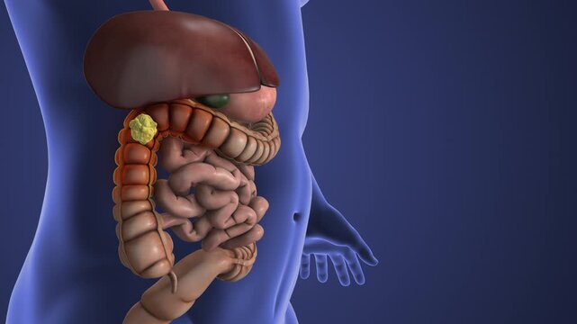 Colon Polyp Developing Inside the Large Intestine
