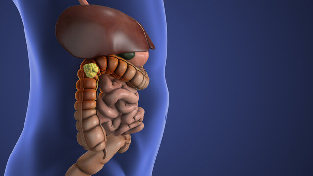 Colon Polyp Developing Inside the Large Intestine