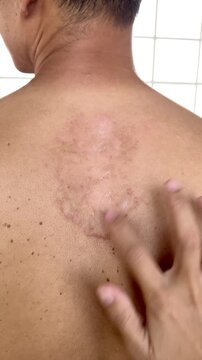 Slow motion vertical close up video of a woman applying anti-itch ointment cream to a large red ringworm rash on her bare back to treat the fungal skin infection.