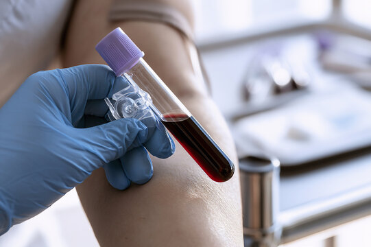 Close up of a phlebotomist drawing blood into a purple top vacuum tube