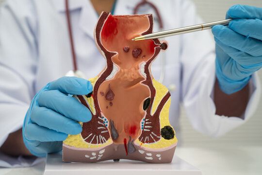Asian doctor with rectum and hemorrhoid human anatomy model at hospital, inflamed vascular structure.