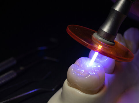 Dental Curing Light Emitting Intense Blue Beam Onto Composite Restoration in Darkened Treatment Room