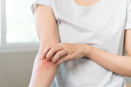 Dermatology asian young woman, girl allergy, allergic reaction from atopic, insect bites on arm, hand in scratching itchy, itch red spot or rash of skin. Healthcare, treatment of beauty concept.