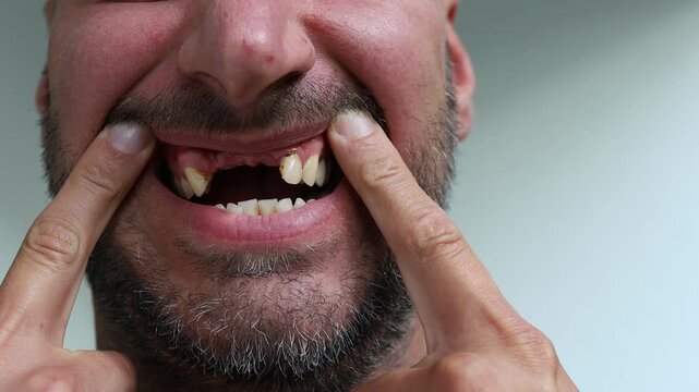 Close-Up Video of Man Showing Missing and Damaged Front Teeth by Pulling Lips Apart