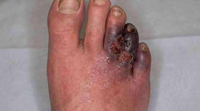 Infected Wet Gangrene and Tissue Necrosis &mdash; Photorealistic Healthcare Background