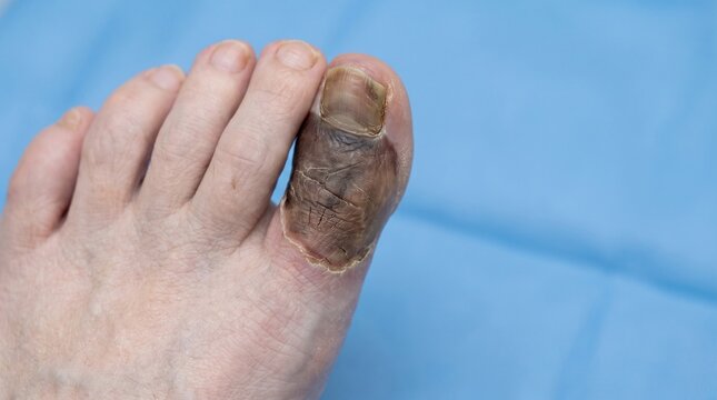 Ischemic Dry Gangrene and Tissue Necrosis &mdash; Photorealistic Medical Background