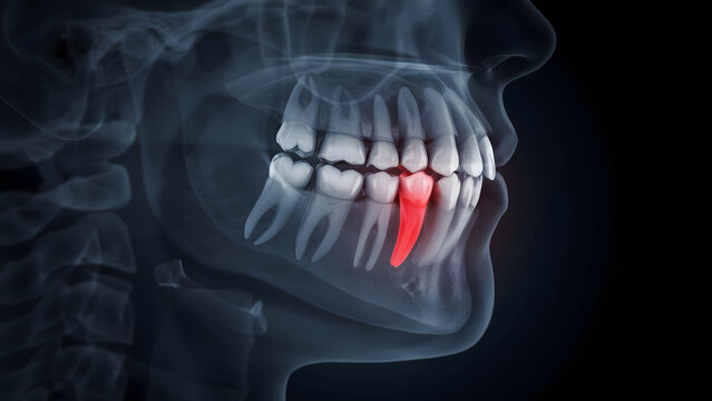 Medical dental digital x-ray of human jaw showing an inflamed tooth