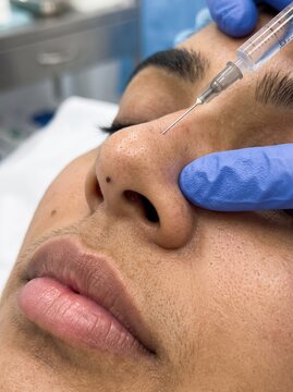 Close-up of a gloved specialist injecting dermal filler into a persons nose, a non surgical rhinoplasty and cosmetic treatment concept.