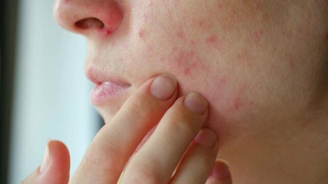 Close up young woman face with skin problem, showing red spots pimples, allergic reaction acne, touches cheek, concerned about dermatological condition. Woman touching facial skin rash allergy pimples