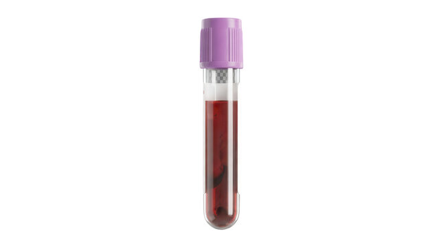 Medical vacuum blood collection tube with purple cap contains specimen for clinical analysis.