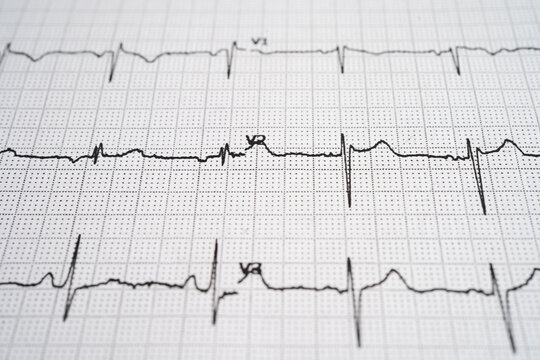 Red heart on electrocardiogram ECG with red heart, heart wave, heart attack, cardiogram report.