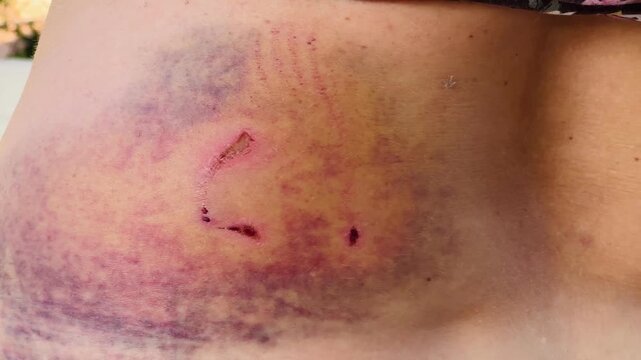 Animal attack dog bite wound and healing bruise video footage