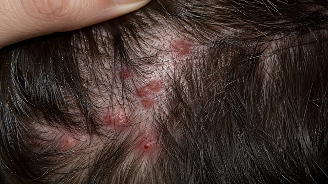 Close up of human scalp with red sores, pimples, and inflammation, folliculitis or skin infection