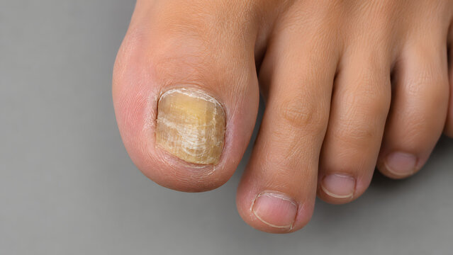 Close up of a human foot with a toenail fungal infection, onychomycosis, showing thick and yellow nail