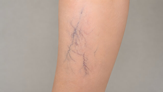 Close up of female leg with varicose veins and spider veins, cardiovascular health problem