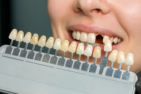 Tooth implant shade selection at dental clinic