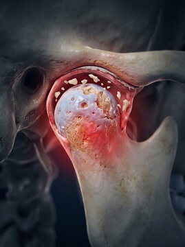  3D animation of mandibular condyle erosion and jaw arthritis