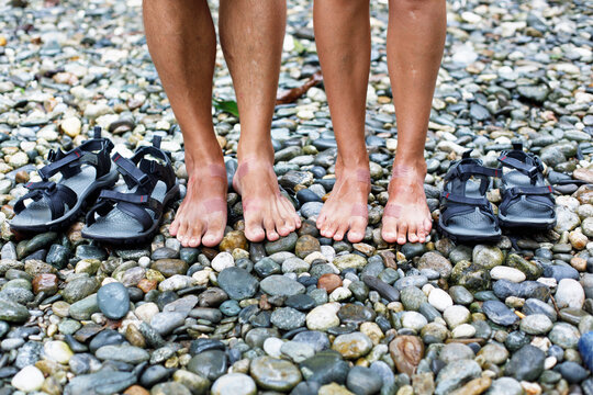 Bloody Blisters and Foot Abrasions Caused by Hiking in Flip-Flops