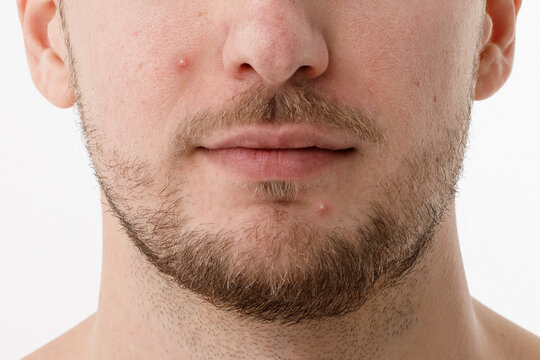 Acne-Prone Facial Skin of a Young Man, Close-Up